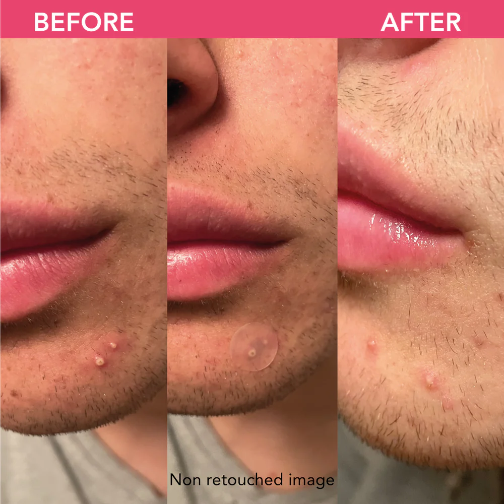 Vorher-Nachher-Bild eines unretuschierten Gesichts mit Akne, das die Verbesserung der Haut nach der Behandlung zeigt.